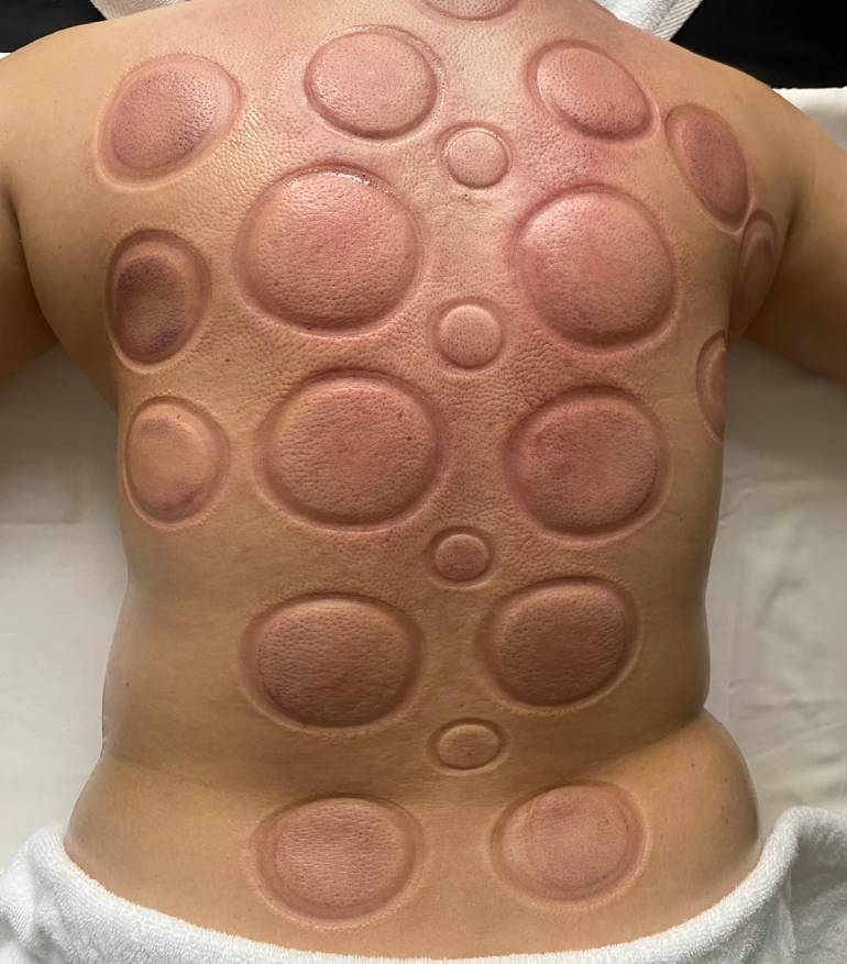 A Deep Dive into the Healing Science of Cupping Therapy Massage and the Loft Thai Spa Experience